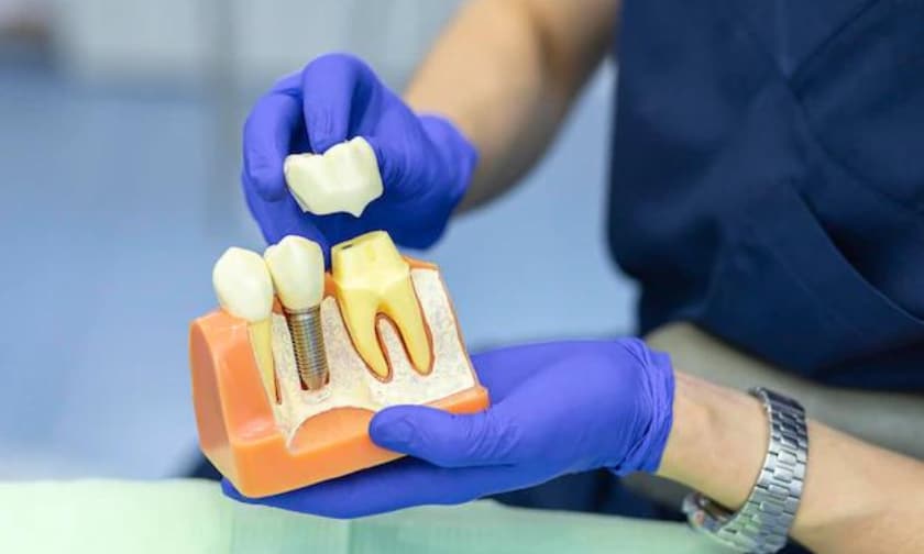 How to Treat Tooth Decay with Dental Crowns