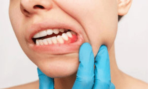 Connection Between Periodontal Disease & Systemic Conditions