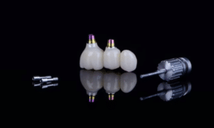 The Latest Technologies in Implant Dentistry & How They are Revolutionizing Oral Care