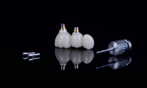 Implant Dentistry