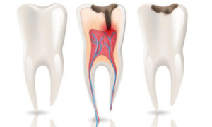 Understanding the Symptoms of a Root Canal Infection