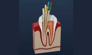 Endodontics in Tullahoma