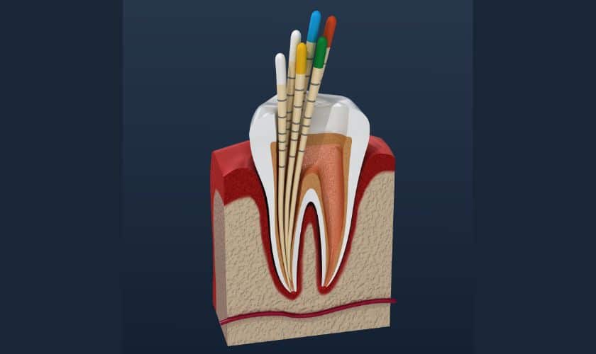 Endodontics in Tullahoma