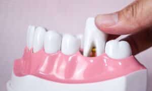 Tooth Extraction in Tullahoma