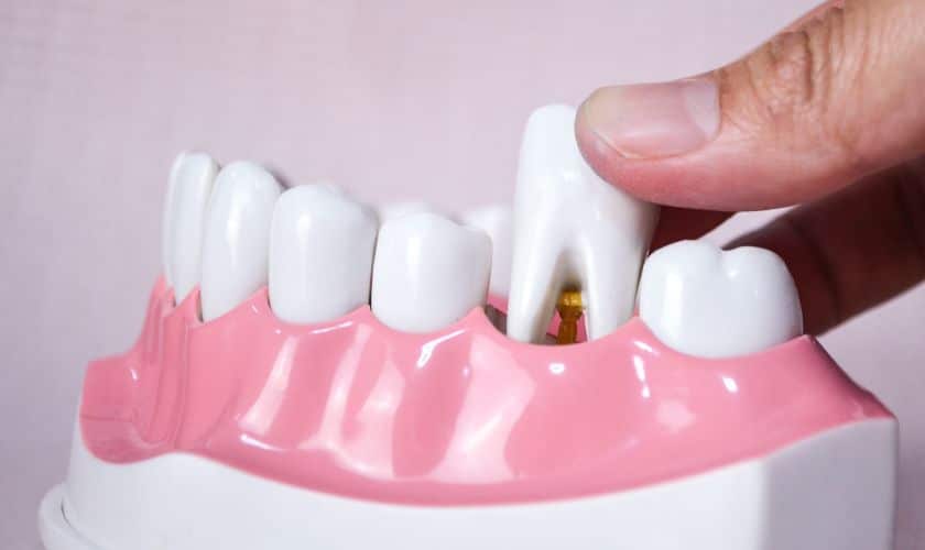 Tooth Extraction in Tullahoma