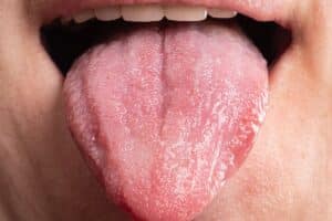 Oral Cancer