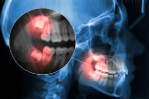 X-ray dental imaging showing teeth and jaw structure with highlighted areas indicating dental examination or treatment analysis.