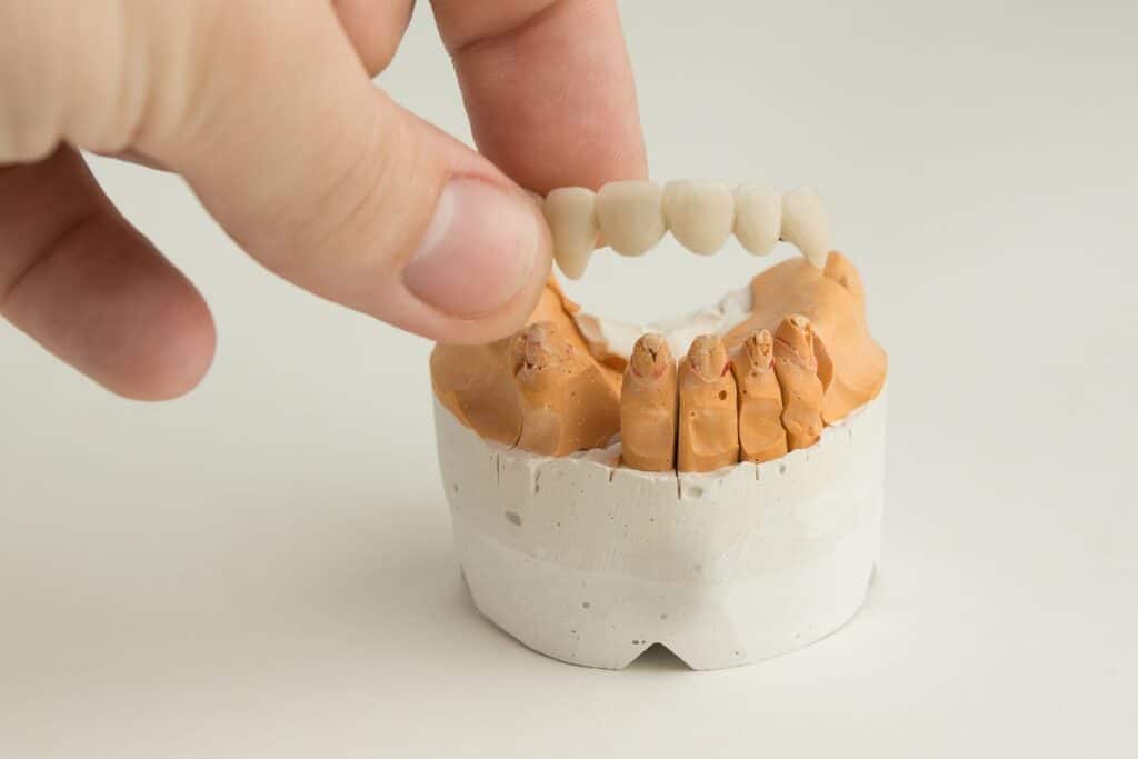 Can a fallen crown be reattached?