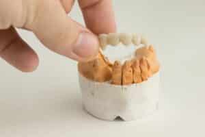 Dental Crowns Fall