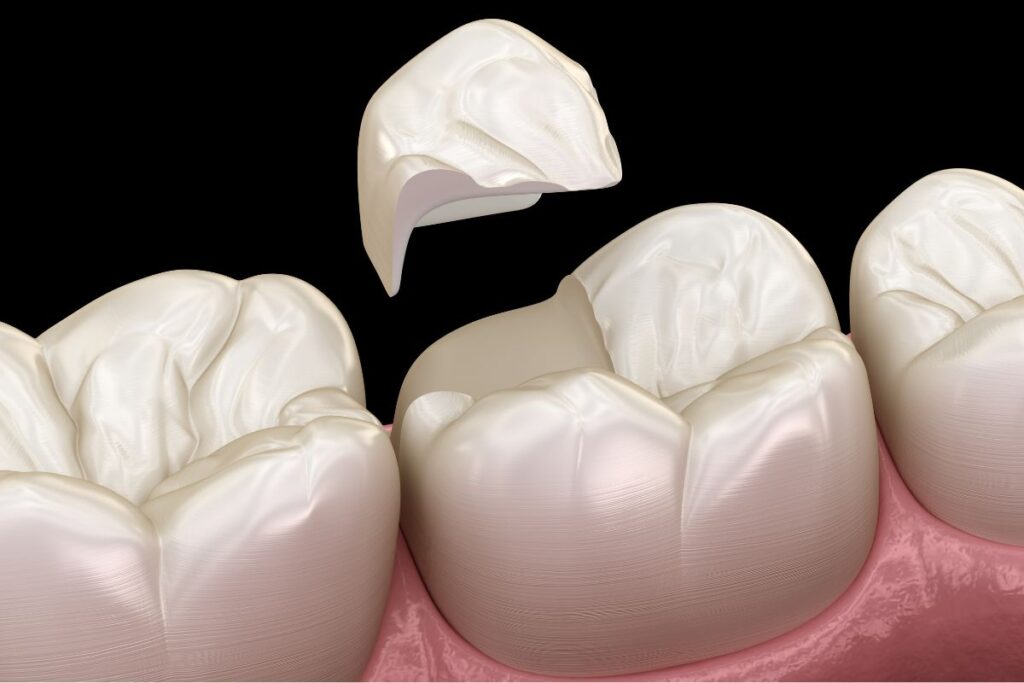 Dental Sealants
