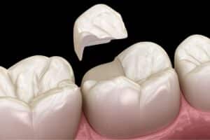 Dental Sealants