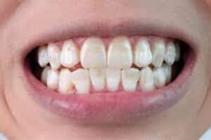 Close-up of person's smile displaying teeth with visible spacing and discoloration issues.