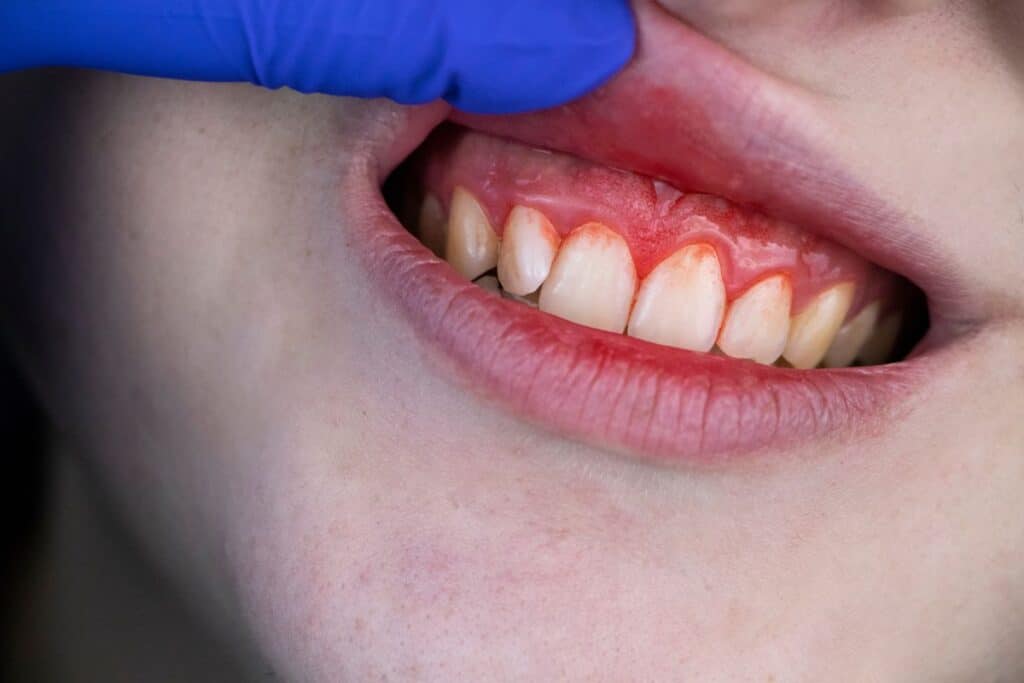How to Stop Bleeding from a Dental Injury