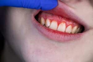 How to Stop Bleeding from a Dental Injury