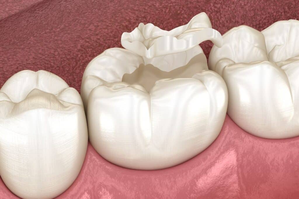 Lost Teeth Filling or Crown