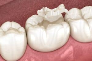 Lost Teeth Filling or Crown