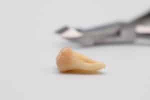 How Long Does Wisdom Tooth Pain Last After Removal