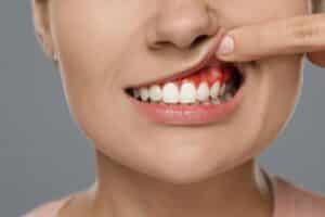 Tooth Abscess