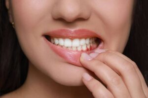 Treat a Tooth Infection