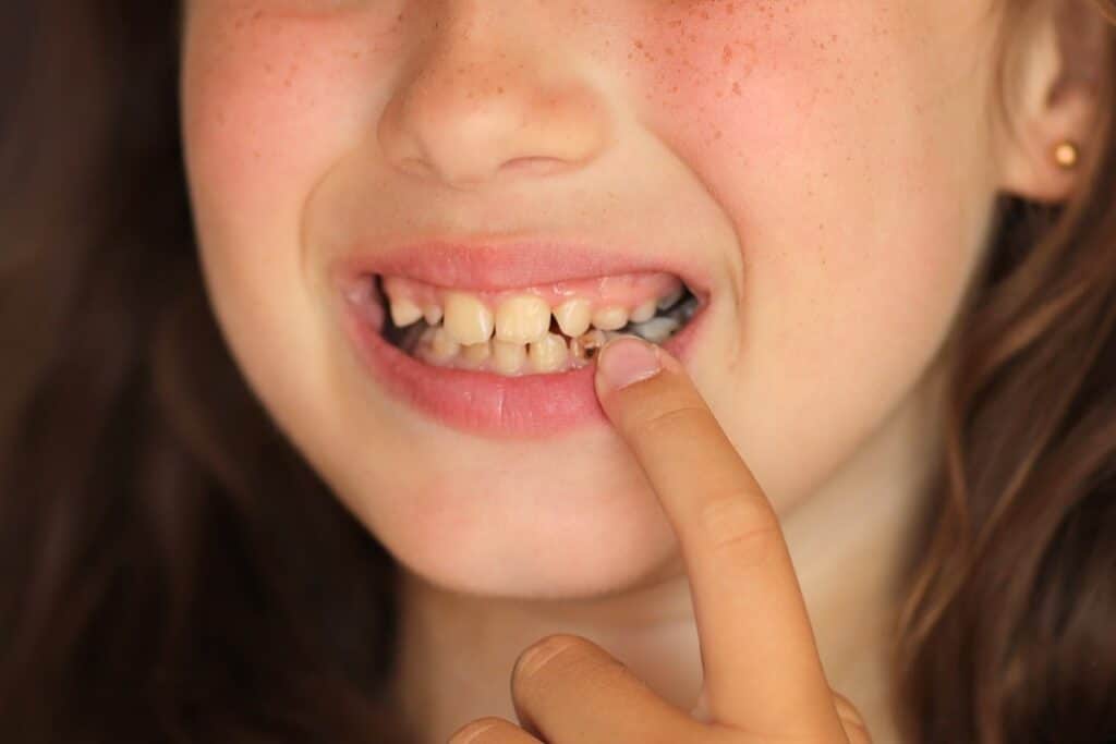 Child displaying braces on teeth while smiling and pointing at mouth with finger.