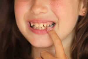 Child displaying braces on teeth while smiling and pointing at mouth with finger.