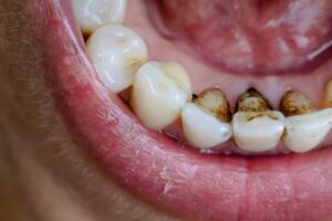 How to Remove Brown Stains From Teeth Naturally