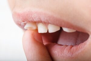 Why Do My Teeth Feel Loose All of a Sudden